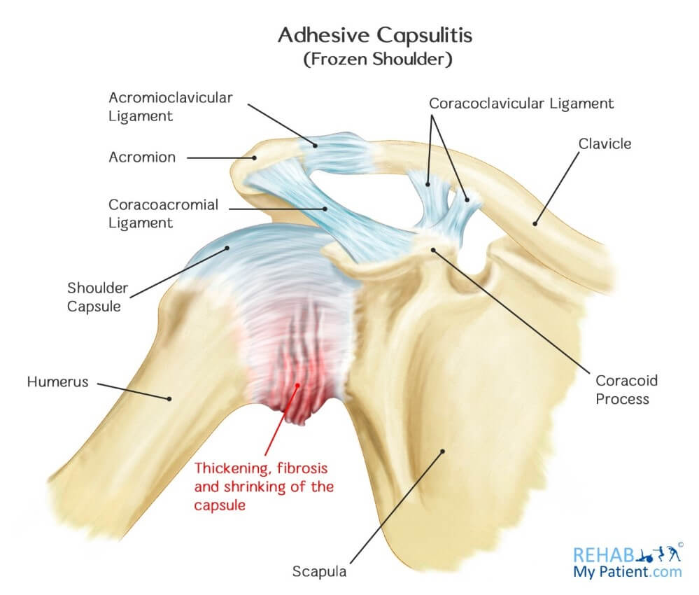 What Is Adhesive Capsulitis Of Left Shoulder